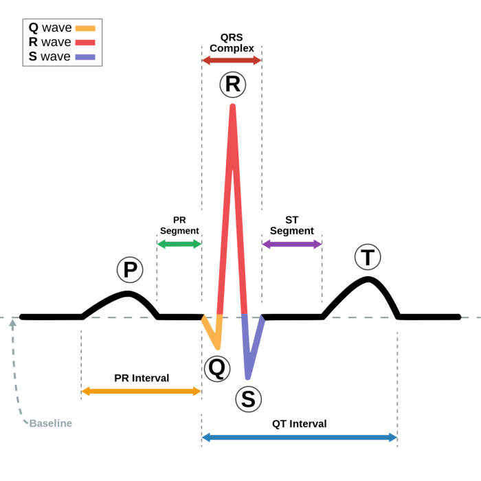 What does an upside down qrs wave mean