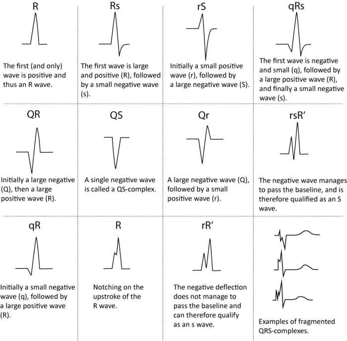 What does an upside down qrs wave mean