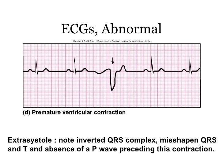 Repolarization ecg early qrs myocardial end ischemia criteria repolarisation acute infarction elevations ekg slurs slurring stemi slur tidig ecgwaves brugada