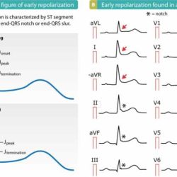 Qrs complex ecg