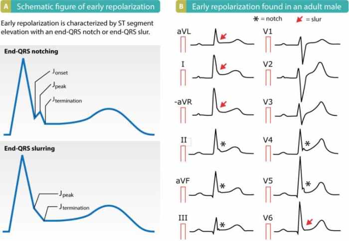 Qrs complex ecg